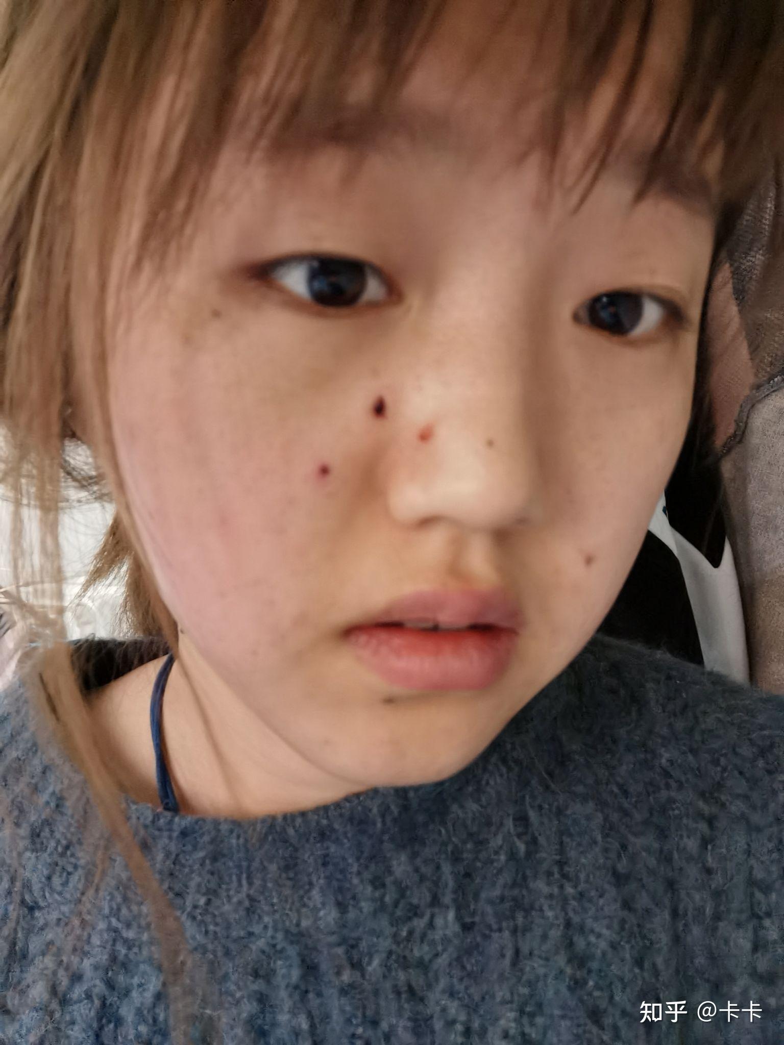 医院点痣价格解析