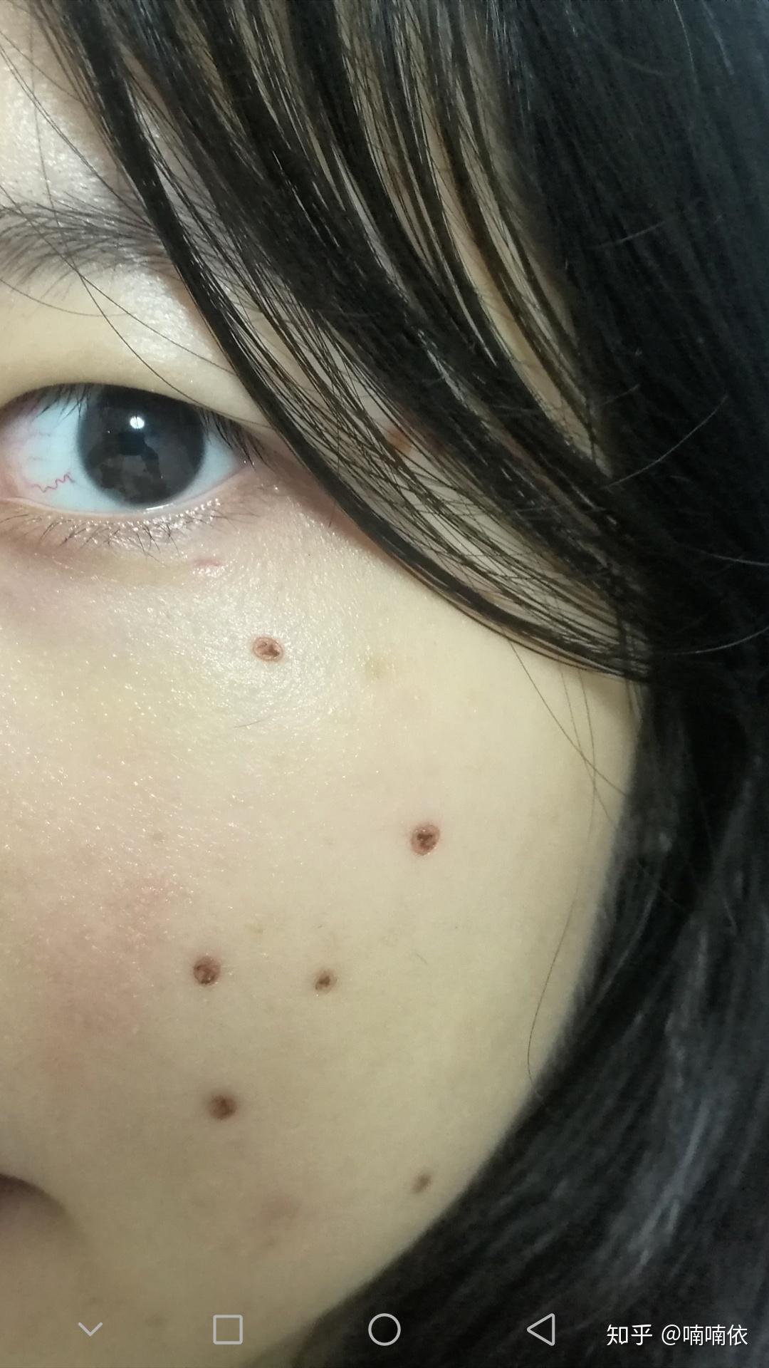 正规医院点痣价格解析