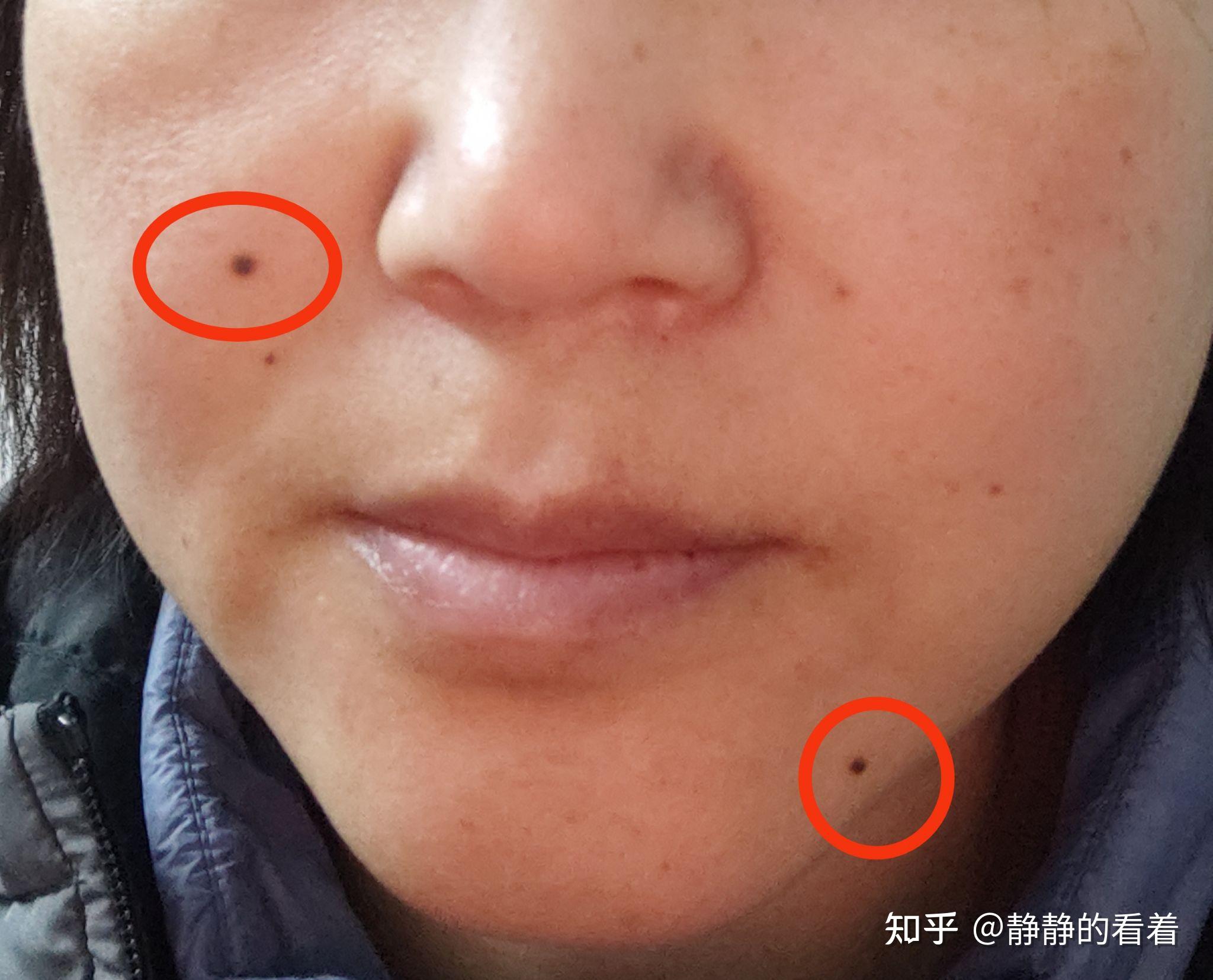 点痣去医院大概多少钱一颗