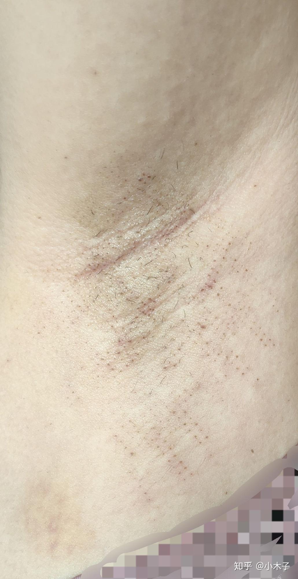 昆明治疗腋臭的医院推荐