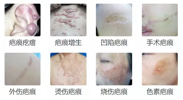 手术后伤口疤痕凸起，科学修复指南
