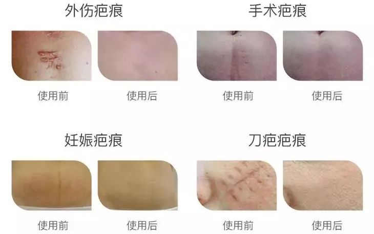 手术疤痕的修复与淡化，科学方法与自然疗法并重