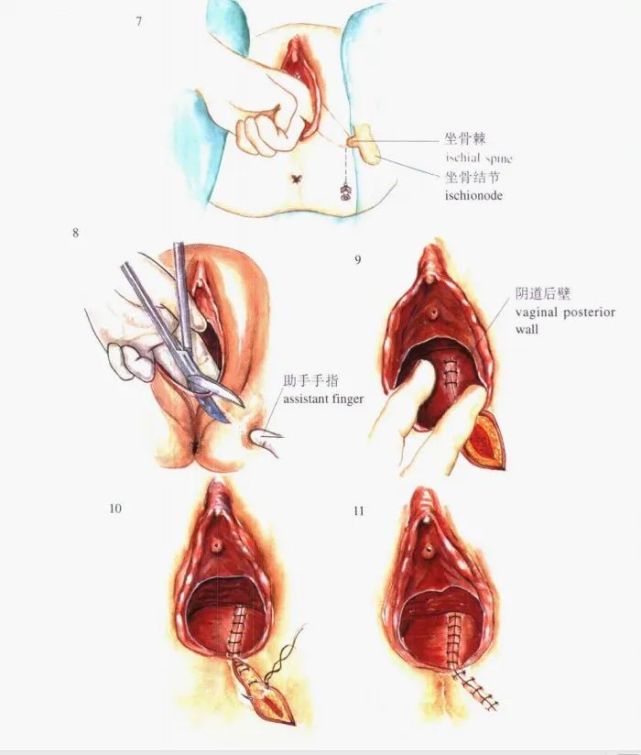 女性常见的小手术概览