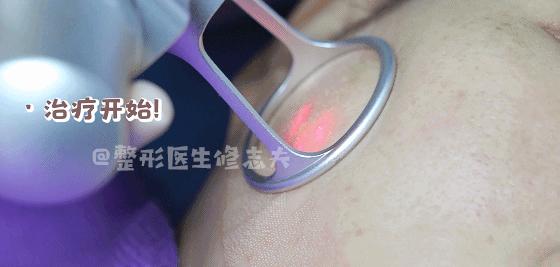 剖腹产手术疤痕能彻底去除吗？——科学解析与现代治疗手段