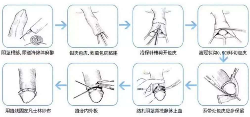 包皮手术疤痕，彻底去除的希望与挑战