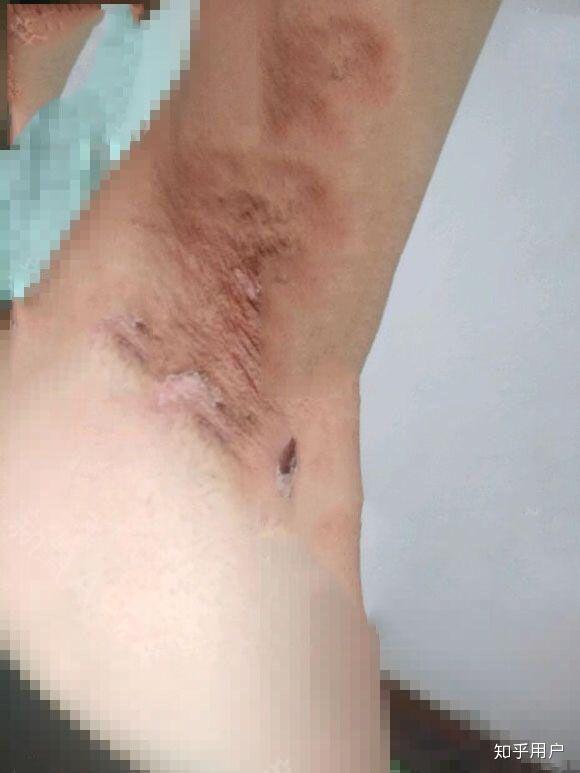 腋臭手术疤痕的去除可能性与策略