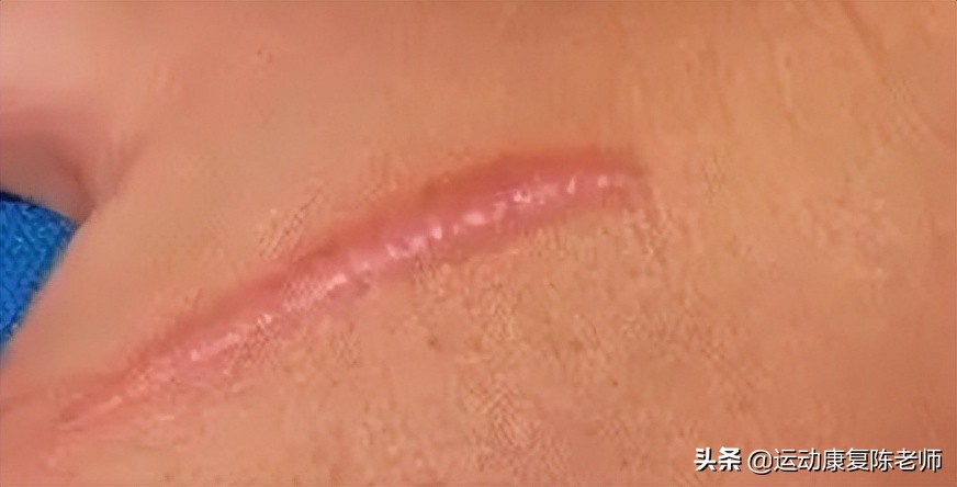手术疤痕的修复之旅，科学方法与自然疗法的完美结合