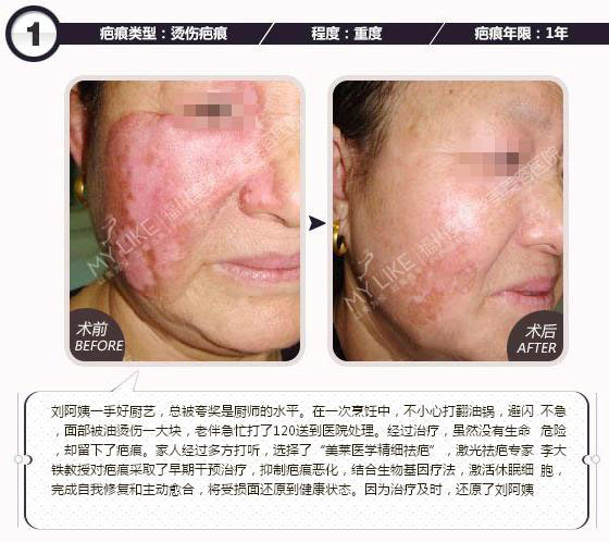 外科手术疤痕的去除与修复，科学方法与自然疗法并重