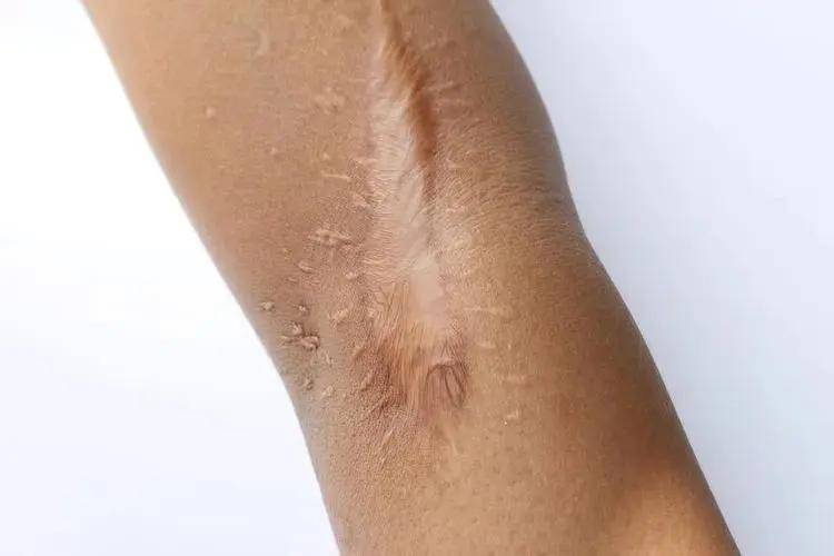 手术疤痕修复医院排名，重塑肌肤之美