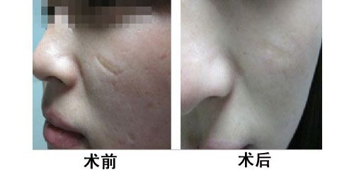 手术伤疤的去除与修复，科学方法与自然疗法并重
