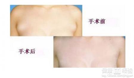 手术疤痕修复的潜在副作用与考量