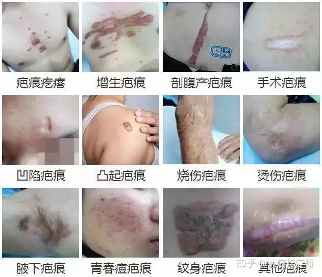 手术疤痕修复费用标准，全面解析与影响因素