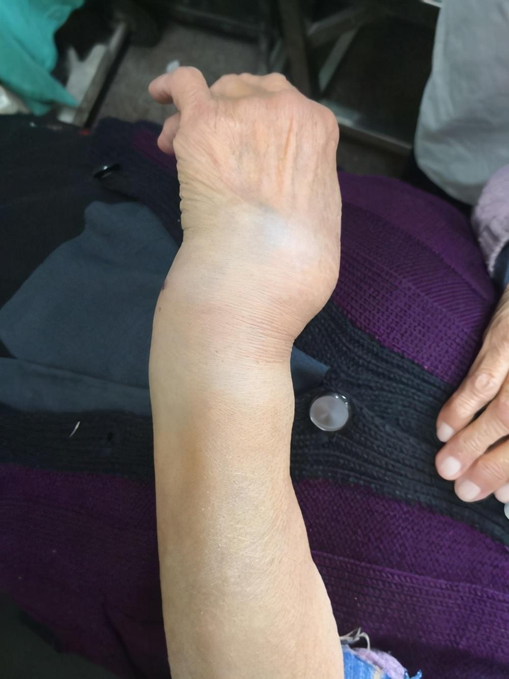适合手术后病人吃的营养品指南