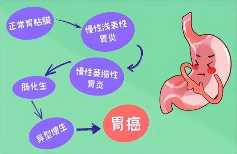 幽门螺旋杆菌，从症状识别到科学治疗的全攻略