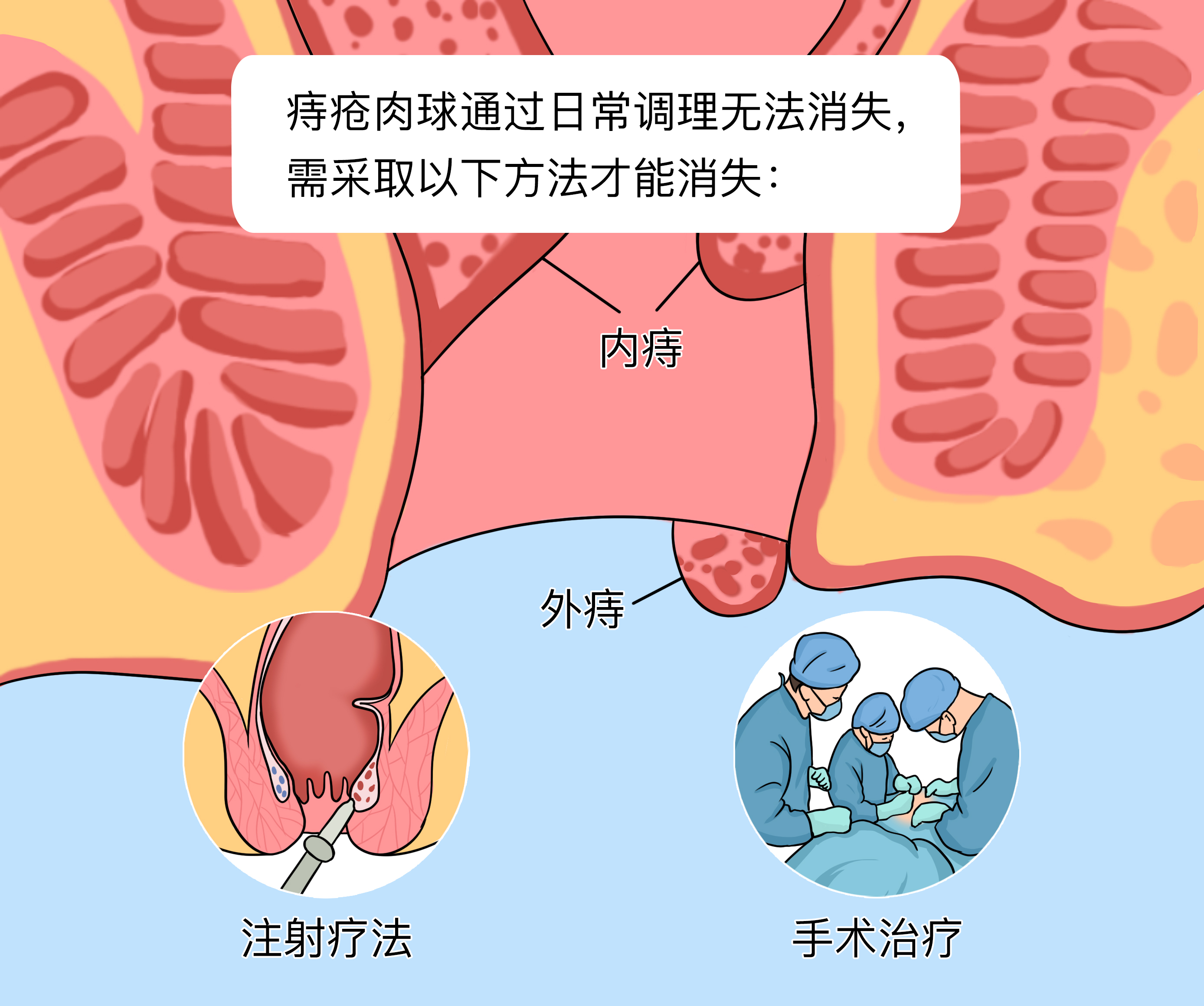 痔疮肉球治疗，科学用药指南