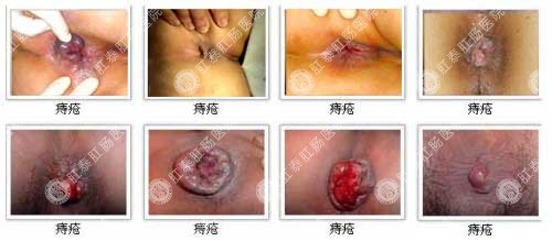 痔疮治疗，哪种药物最有效？
