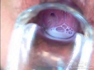 彻底根除霉菌性阴炎，科学治疗与日常护理并重