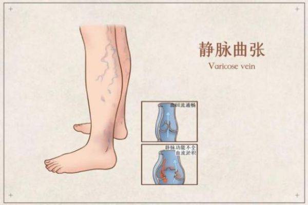 探索治疗静脉曲张最根本有效的方法，从根源到实践的全面解析