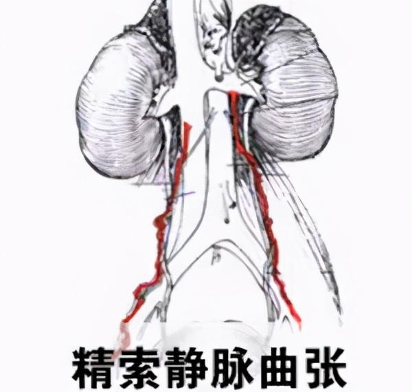最新治疗静脉曲张方法的探索与进展