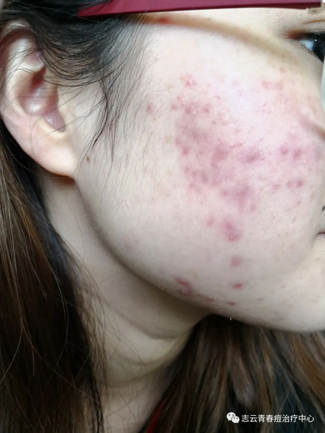 青少年痤疮最佳治疗方法，科学、安全与综合管理