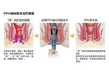 痔疮小肉球，科学治疗与日常护理的全面指南