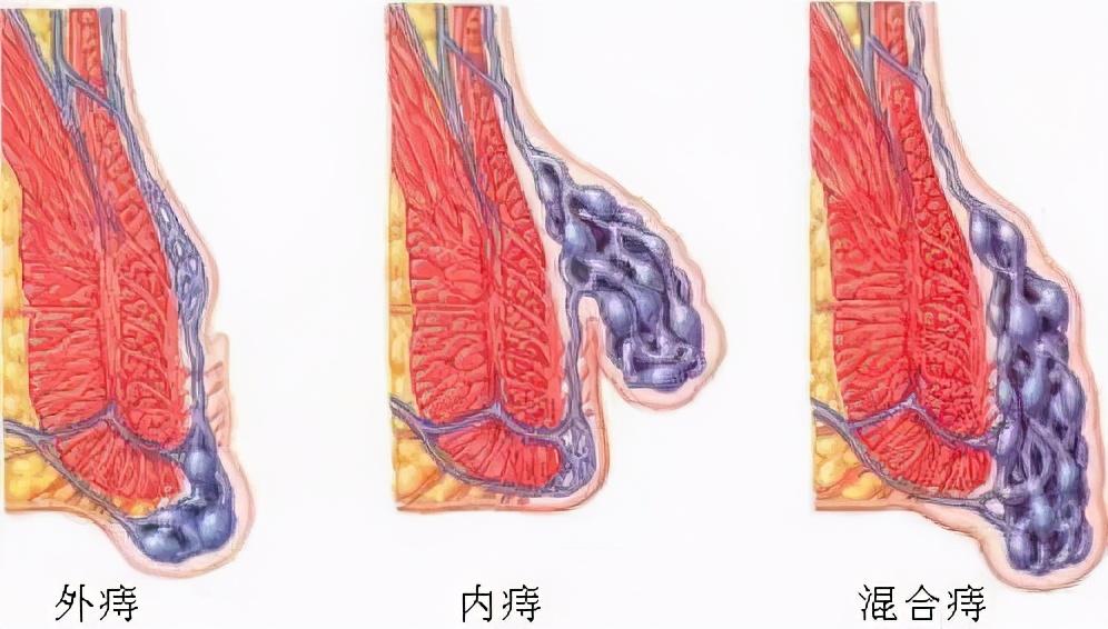 痔疮内痔的全面治疗方法，从理解到康复的全面指南