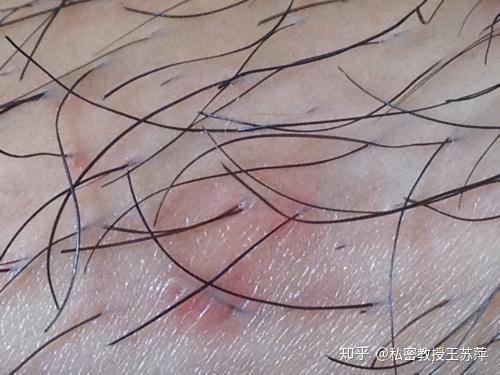 男性阴虱最佳治疗策略，全面解析与科学指导