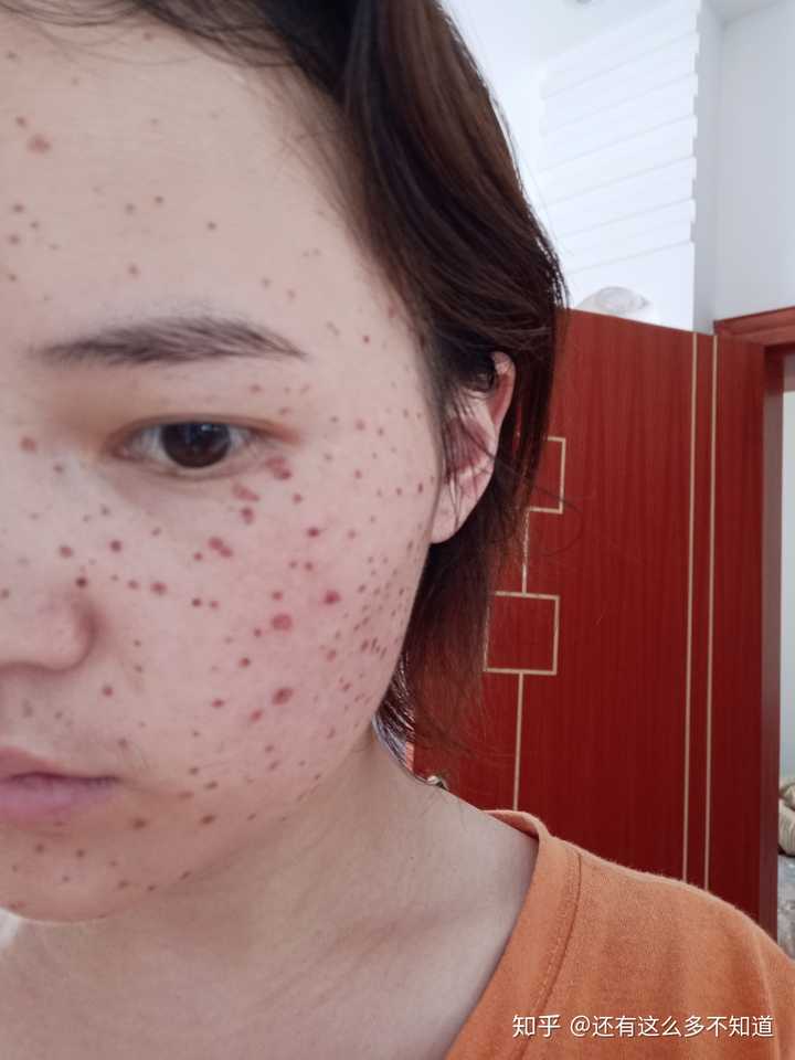 医院与美容院点痣之争，安全与效果的权衡