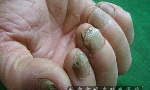 探寻北京灰指甲治疗新篇章，三甲医院的权威之选